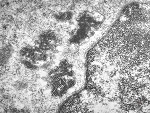 M,18y. | blood - tubular inclusions in lymphocytes M,18y. | blood - tubular inclusions in lymphocytes